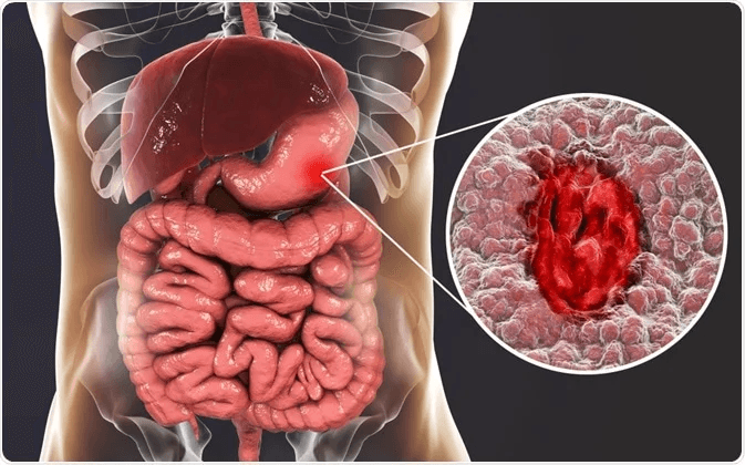 Anatomical illustration of the human digestive system showing an ulcer on the stomach lining